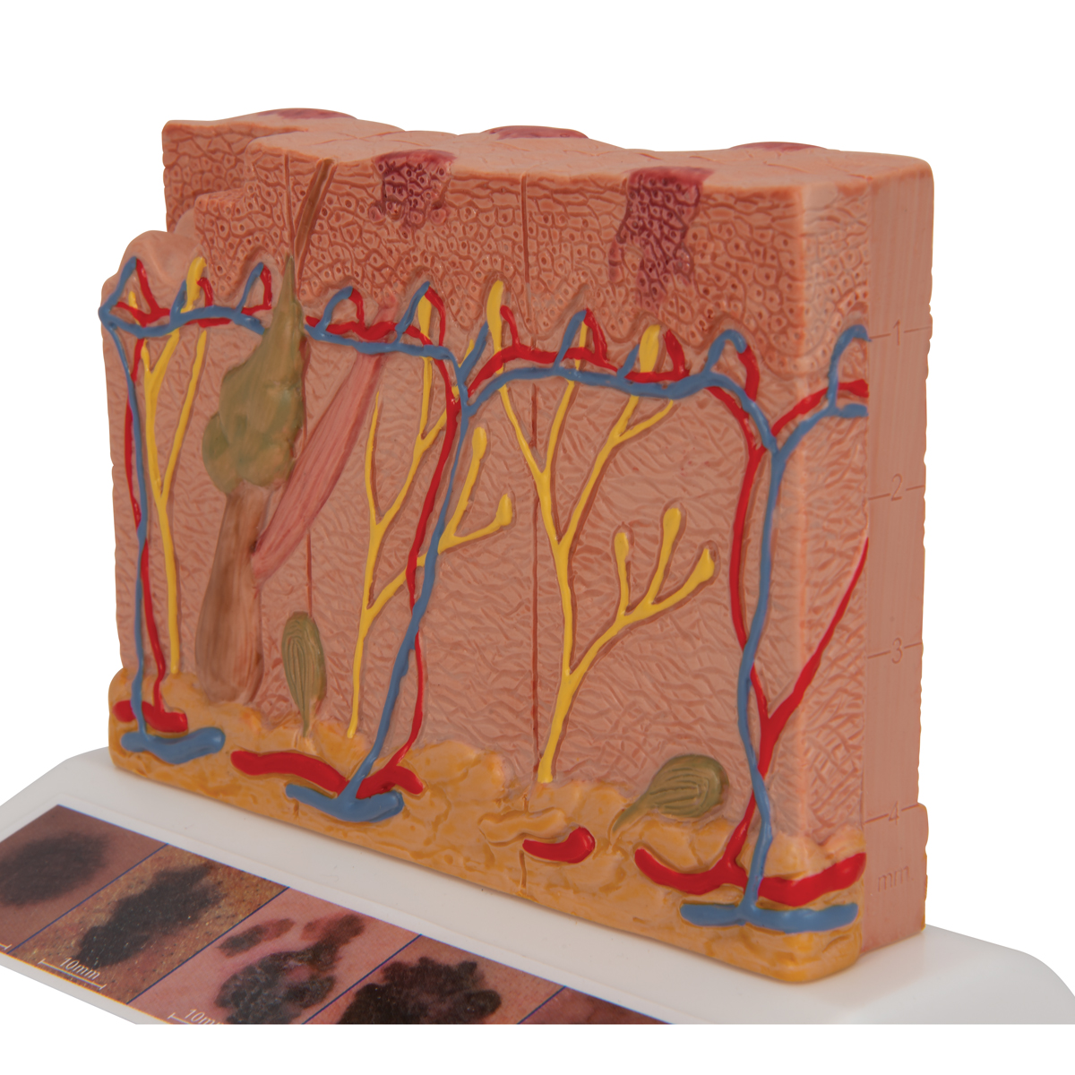 Model cancer de piele, material didactic biologie